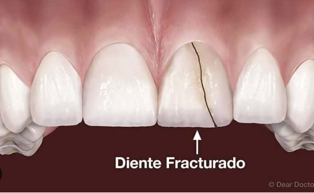 ¿Cuando ya no se puede realizar una endodoncia?