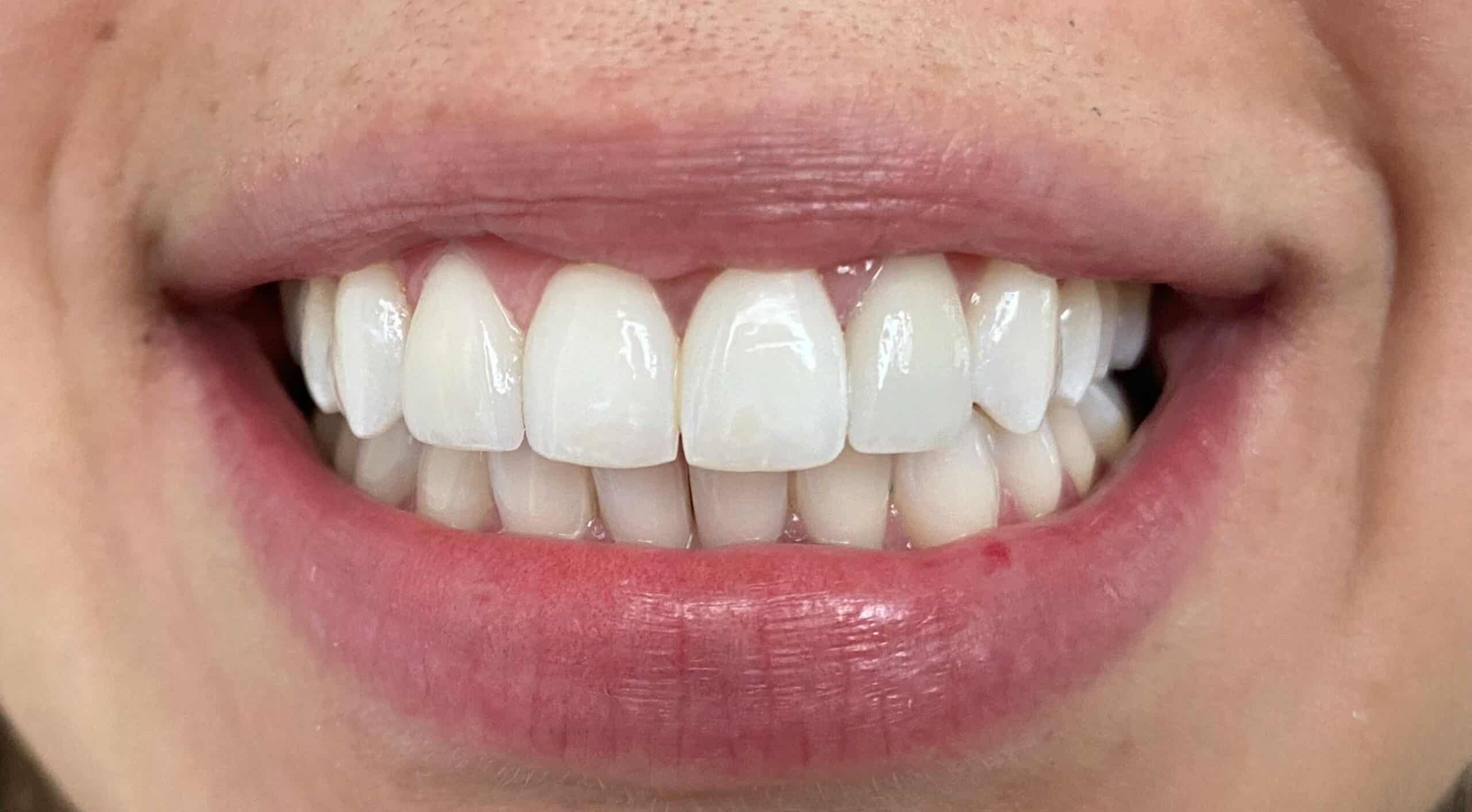 What are Dental Veneers? - iSmile Guatemala