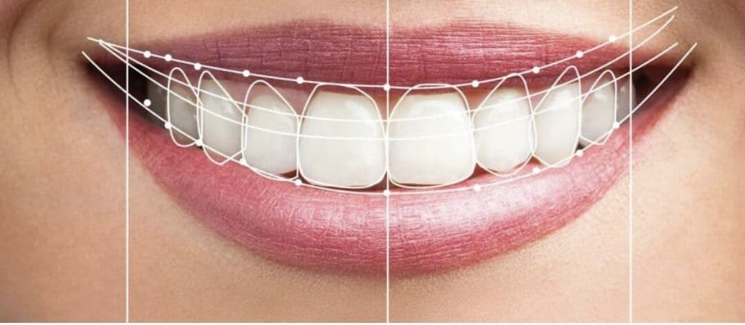 What is a digital smile design?