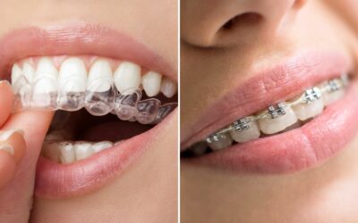 Diferencias entre ortodoncia tradicional y alineadores transparentes
