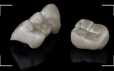 Carillas Dentales vs. Coronas Dentales: ¿Cuándo recurrir a cada tratamiento?