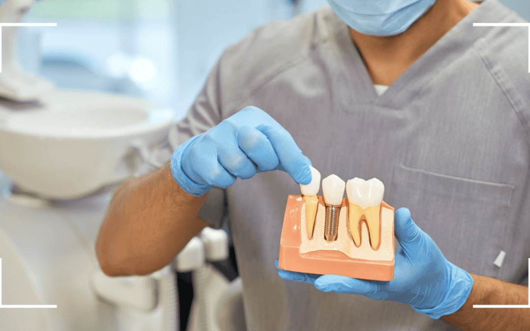 ¡Implantes Dentales vs. Puentes Dentales: ¿Cuál es la mejor opción para ti?