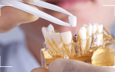 ¿Cuánto duran los implantes dentales según su tipo de material?